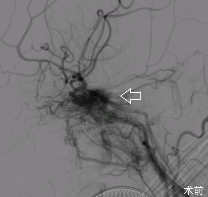 術(shù)前造影示海綿竇區(qū)硬腦膜動靜脈瘺.jpg